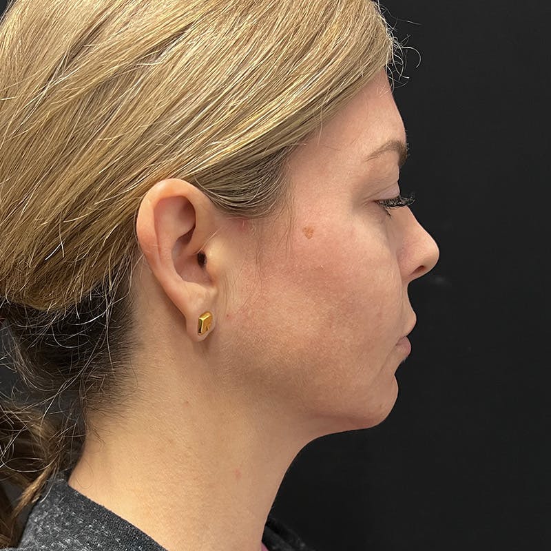 SkinTyte Before & After Gallery - Patient 201480858 - Image 3