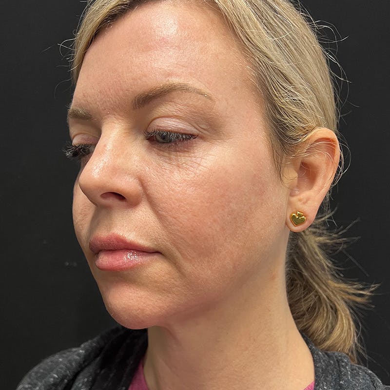 SkinTyte Before & After Gallery - Patient 201480858 - Image 5