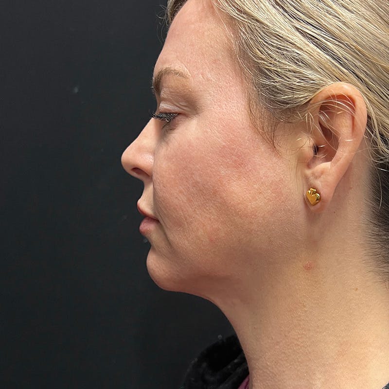 SkinTyte Before & After Gallery - Patient 201480858 - Image 7