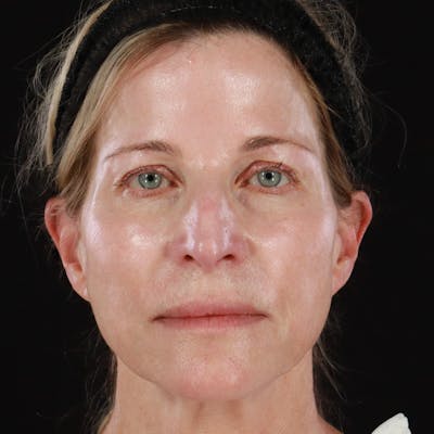 HALO™ Laser Treatment Before & After Gallery - Patient 201484986 - Image 1