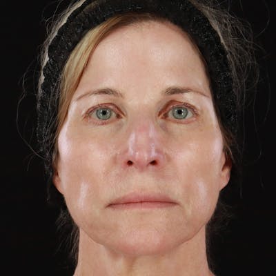 HALO™ Laser Treatment Before & After Gallery - Patient 201484986 - Image 2