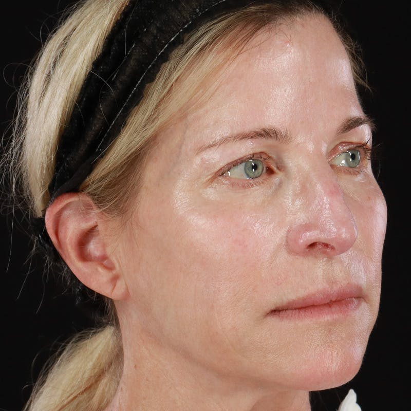 HALO™ Laser Treatment Before & After Gallery - Patient 201484986 - Image 3
