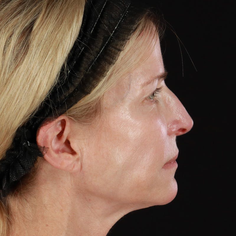 HALO™ Laser Treatment Before & After Gallery - Patient 201484986 - Image 5