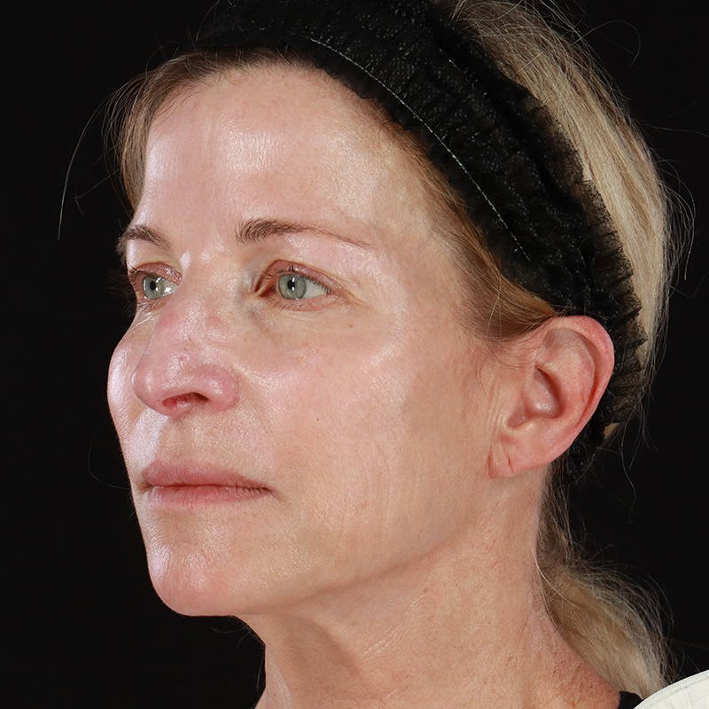 HALO™ Laser Treatment Before & After Gallery - Patient 201484986 - Image 7