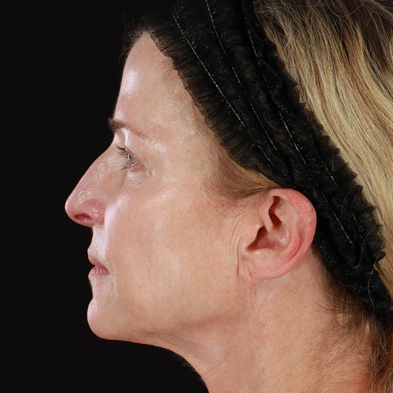 HALO™ Laser Treatment Before & After Gallery - Patient 201484986 - Image 9