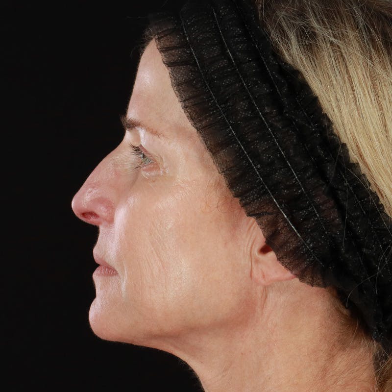 HALO™ Laser Treatment Before & After Gallery - Patient 201484986 - Image 10