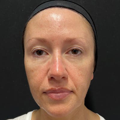 HALO™ Laser Treatment Before & After Gallery - Patient 201484979 - Image 1