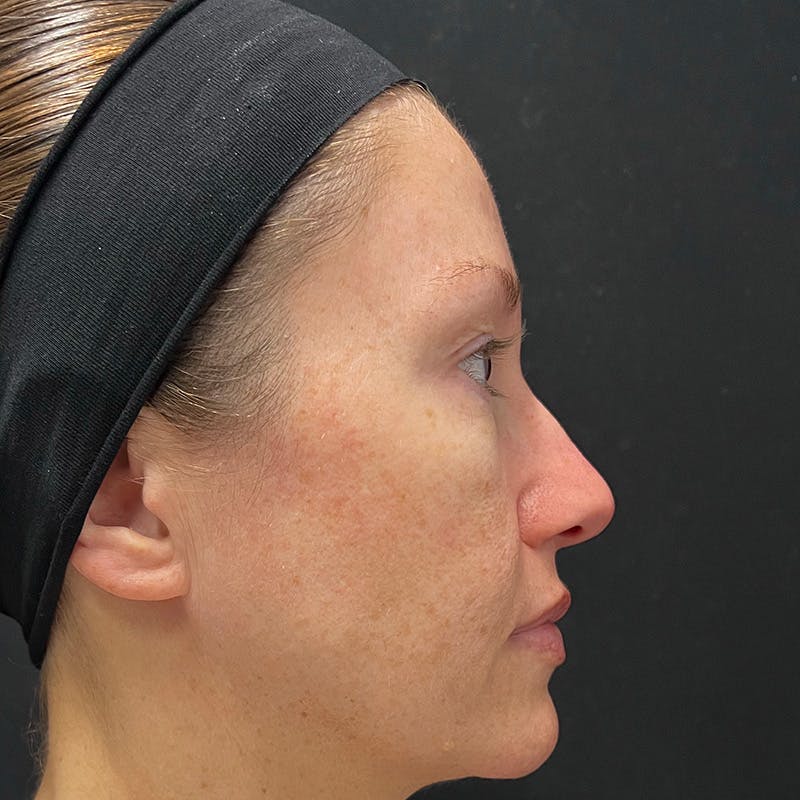 HALO™ Laser Treatment Before & After Gallery - Patient 201484979 - Image 3