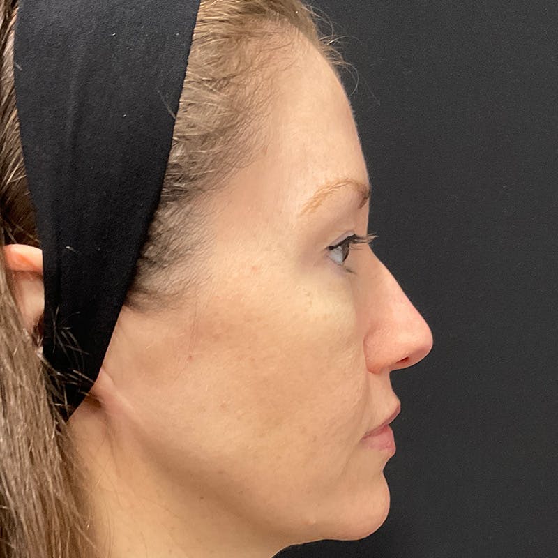 HALO™ Laser Treatment Before & After Gallery - Patient 201484979 - Image 4