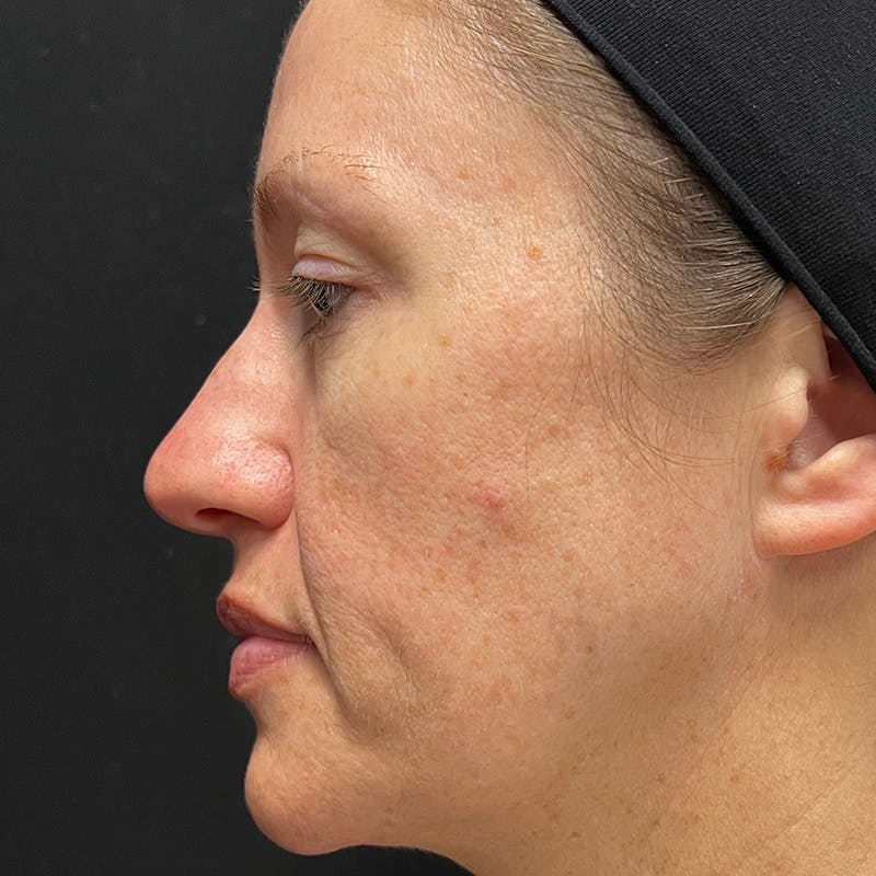 HALO™ Laser Treatment Before & After Gallery - Patient 201484979 - Image 5