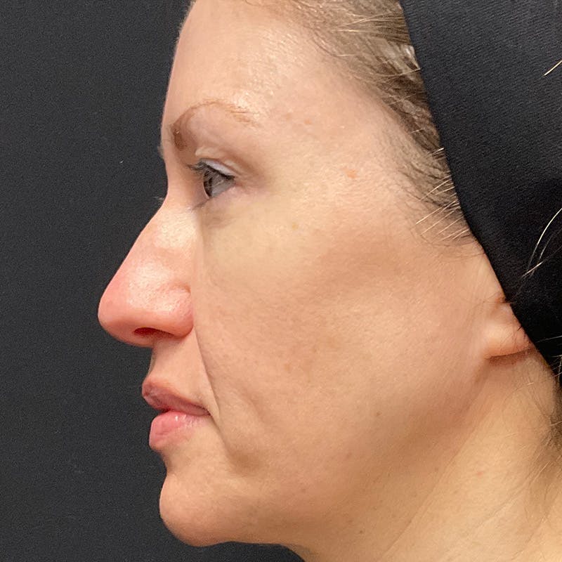 HALO™ Laser Treatment Before & After Gallery - Patient 201484979 - Image 6