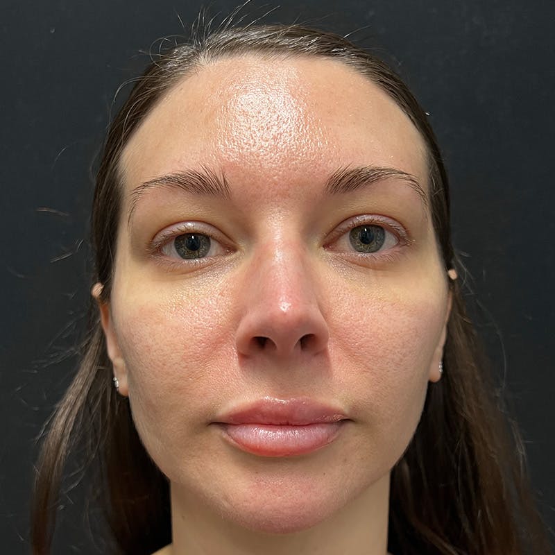 HALO™ Laser Treatment Before & After Gallery - Patient 201484860 - Image 1