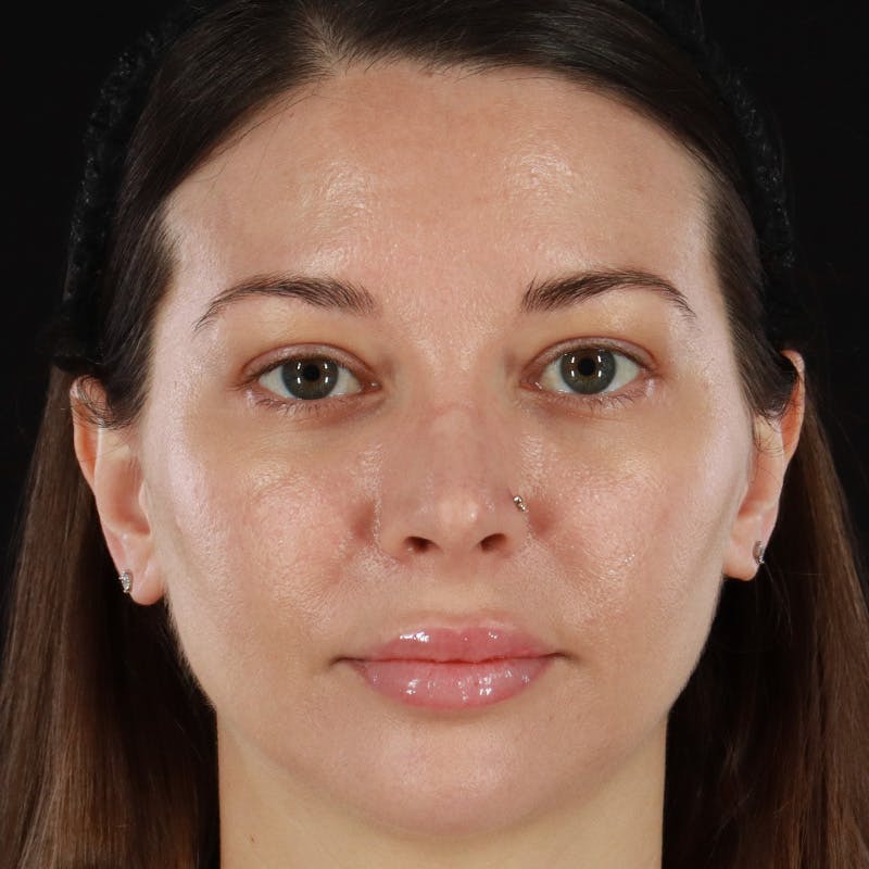 HALO™ Laser Treatment Before & After Gallery - Patient 201484860 - Image 2