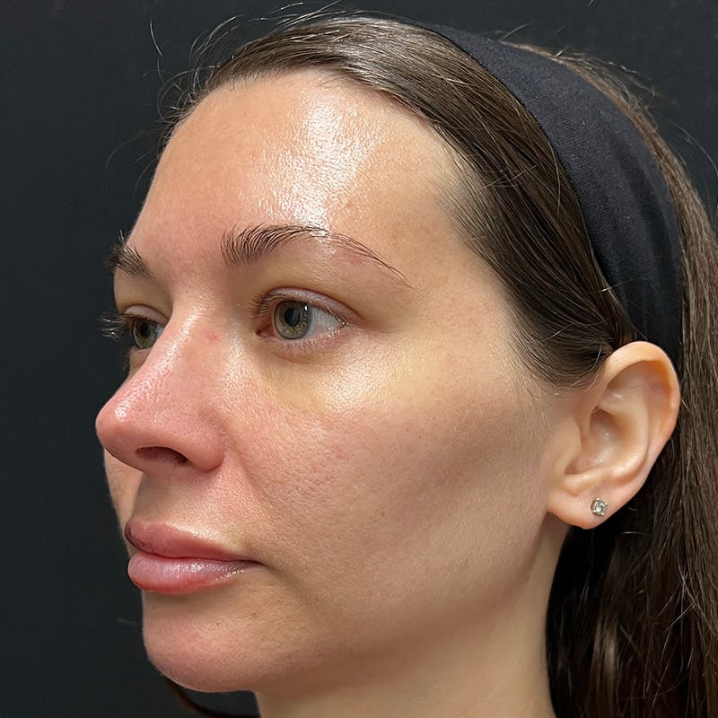 HALO™ Laser Treatment Before & After Gallery - Patient 201484860 - Image 5