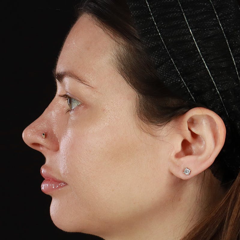 HALO™ Laser Treatment Before & After Gallery - Patient 201484860 - Image 8