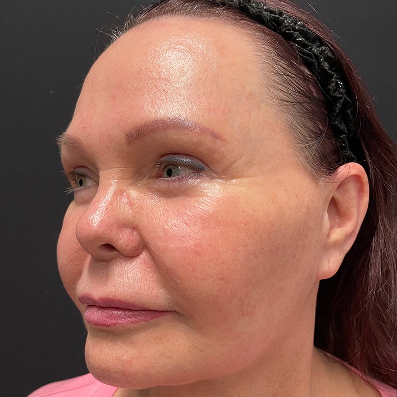 HALO™ Laser Treatment Before & After Gallery - Patient 201484859 - Image 7