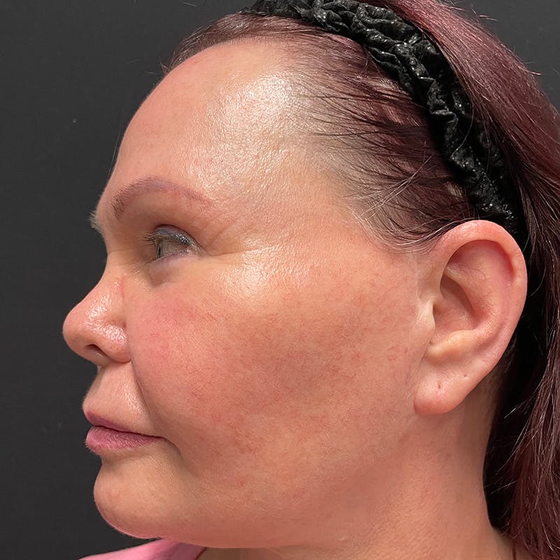 HALO™ Laser Treatment Before & After Gallery - Patient 201484859 - Image 9