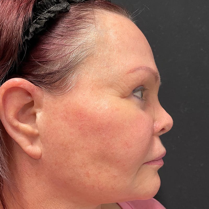 HALO™ Laser Treatment Before & After Gallery - Patient 201484859 - Image 5
