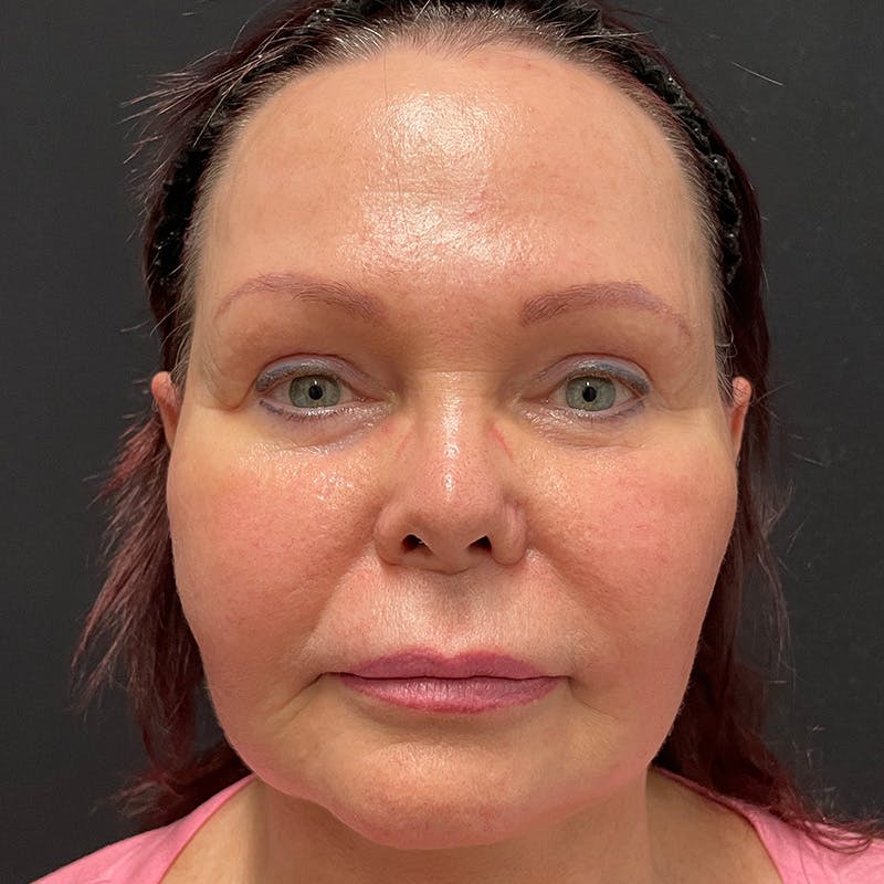 HALO™ Laser Treatment Before & After Gallery - Patient 201484859 - Image 1