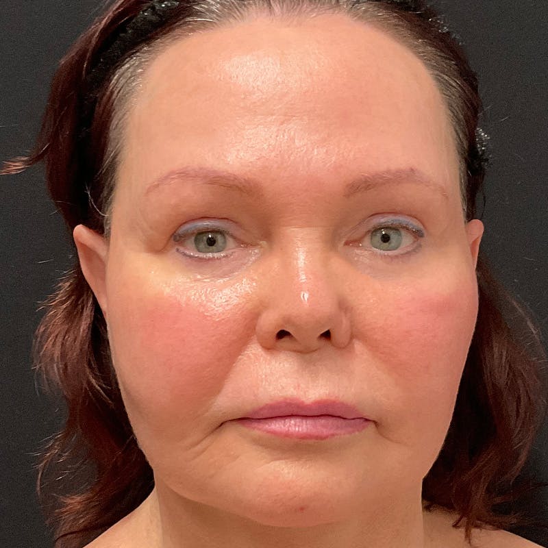 HALO™ Laser Treatment Before & After Gallery - Patient 201484859 - Image 2