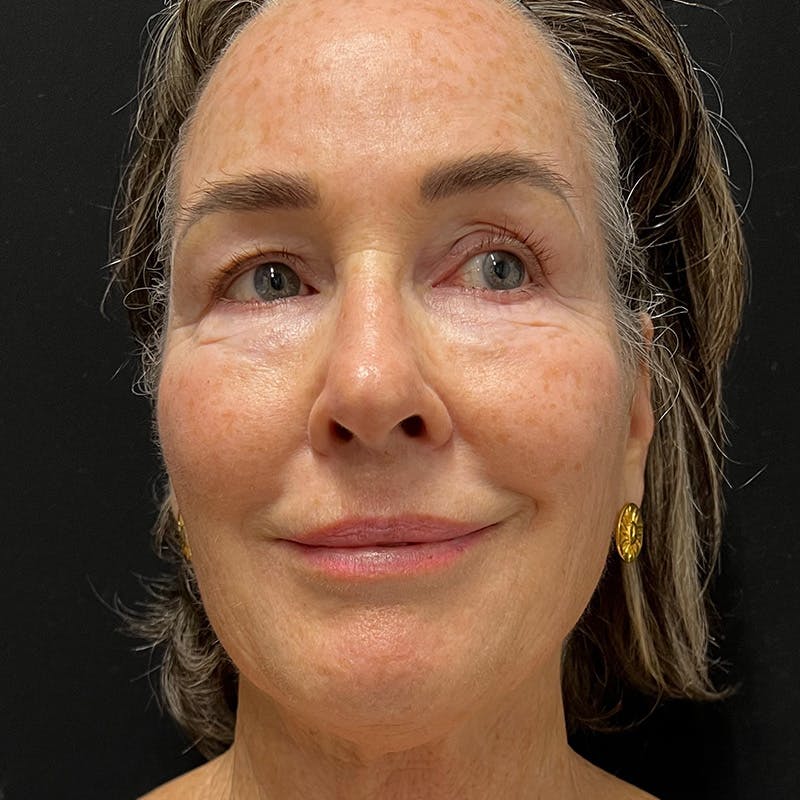 HALO™ Laser Treatment Before & After Gallery - Patient 201484857 - Image 1