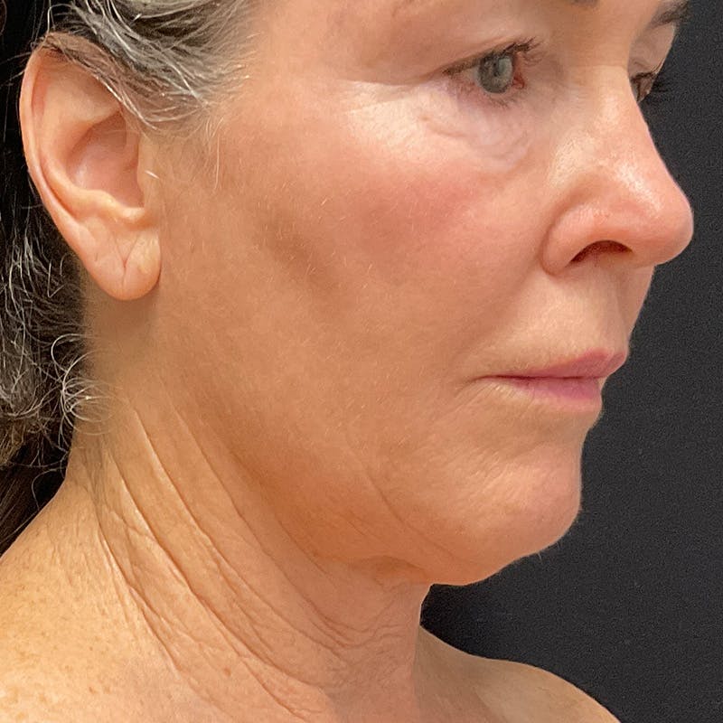 HALO™ Laser Treatment Before & After Gallery - Patient 201484857 - Image 4