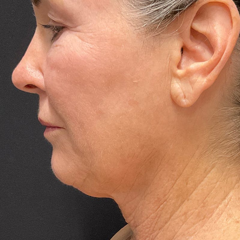 HALO™ Laser Treatment Before & After Gallery - Patient 201484857 - Image 6