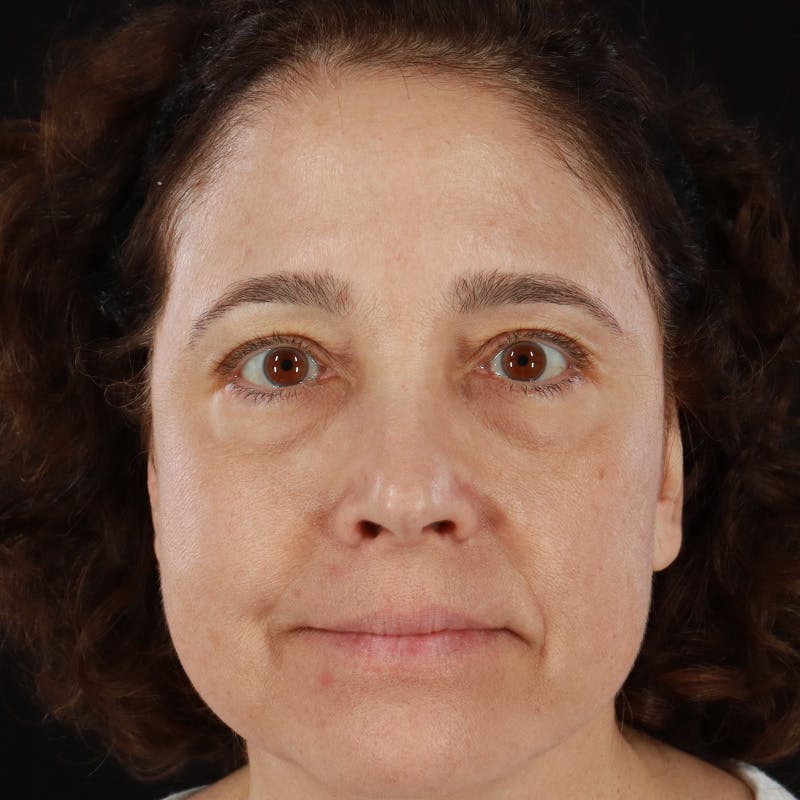 HALO™ Laser Treatment Before & After Gallery - Patient 201484855 - Image 1