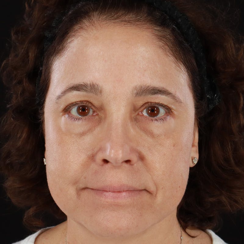 Botox/Dysport/Jeuveau Before & After Gallery - Patient 201487550 - Image 2