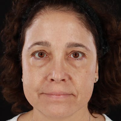 HALO™ Laser Treatment Before & After Gallery - Patient 201484855 - Image 2