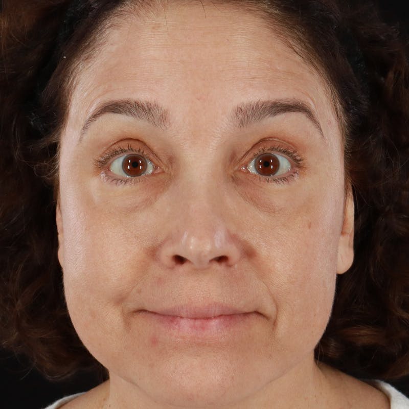 Botox/Dysport/Jeuveau Before & After Gallery - Patient 201487550 - Image 3