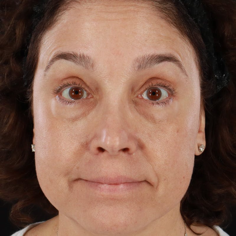 Botox/Dysport/Jeuveau Before & After Gallery - Patient 201487550 - Image 4