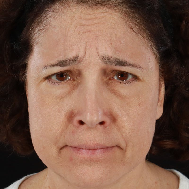 Botox/Dysport/Jeuveau Before & After Gallery - Patient 201487550 - Image 5