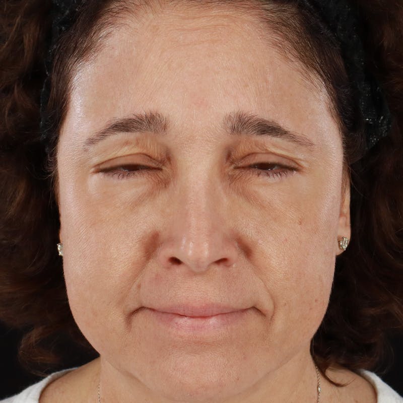 Botox/Dysport/Jeuveau Before & After Gallery - Patient 201487550 - Image 6