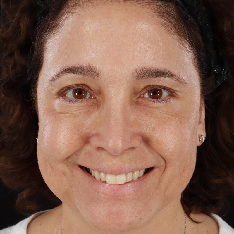 Botox/Dysport/Jeuveau Before & After Gallery - Patient 201487550 - Image 8
