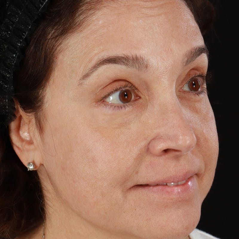 Botox/Dysport/Jeuveau Before & After Gallery - Patient 201487550 - Image 14