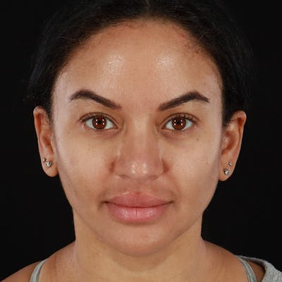 Dermal Fillers Before & After Gallery - Patient 201487559 - Image 2