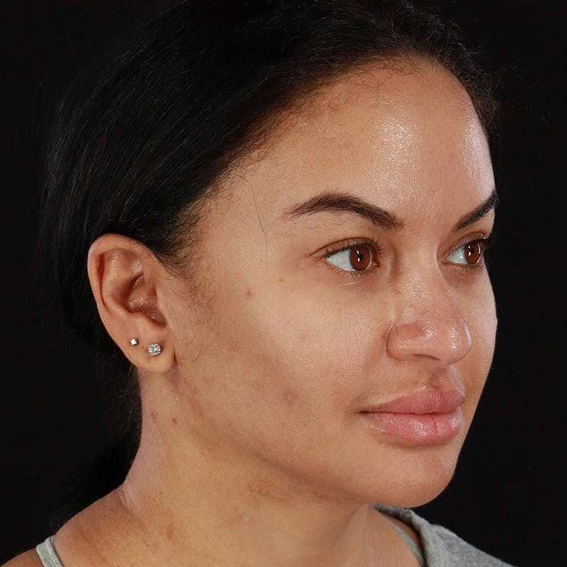 Dermal Fillers Before & After Gallery - Patient 201487559 - Image 4