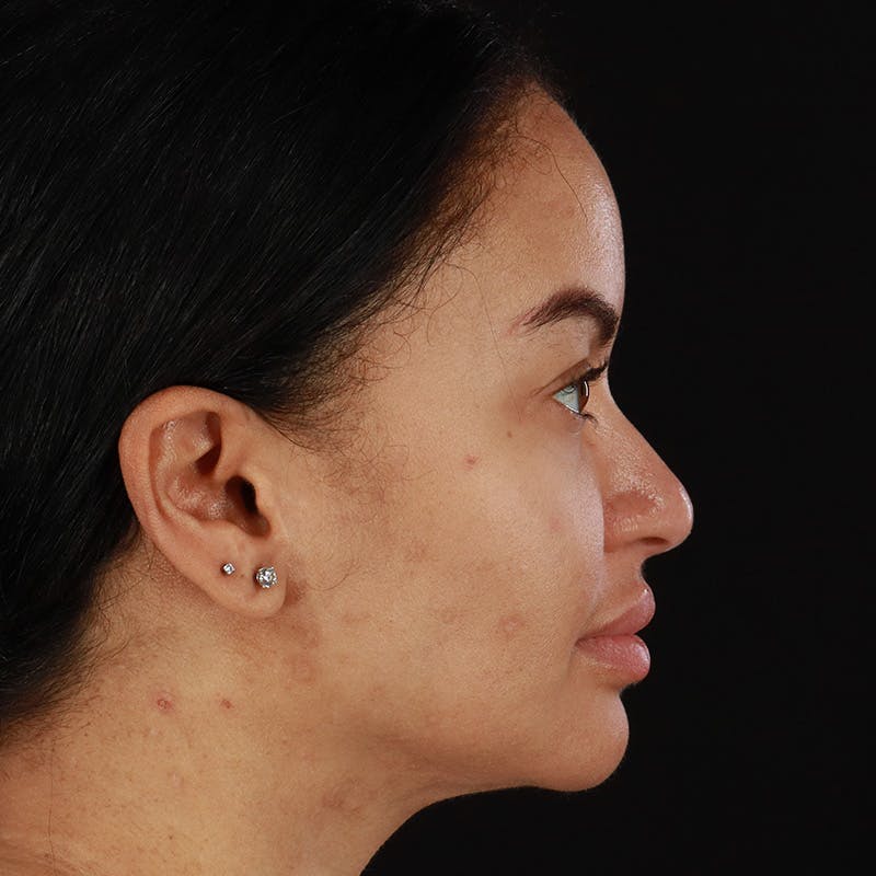 Dermal Fillers Before & After Gallery - Patient 201487559 - Image 6