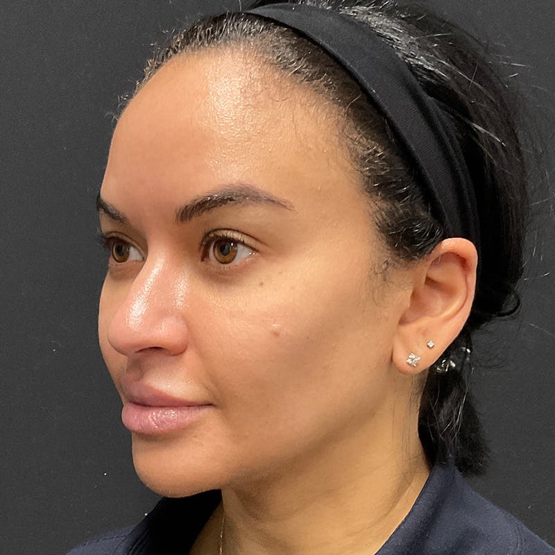 Dermal Fillers Before & After Gallery - Patient 201487559 - Image 7