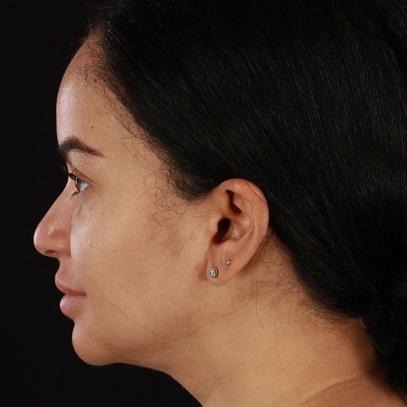 Dermal Fillers Before & After Gallery - Patient 201487559 - Image 10