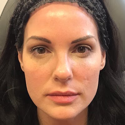 Dermal Fillers Before & After Gallery - Patient 201487567 - Image 2