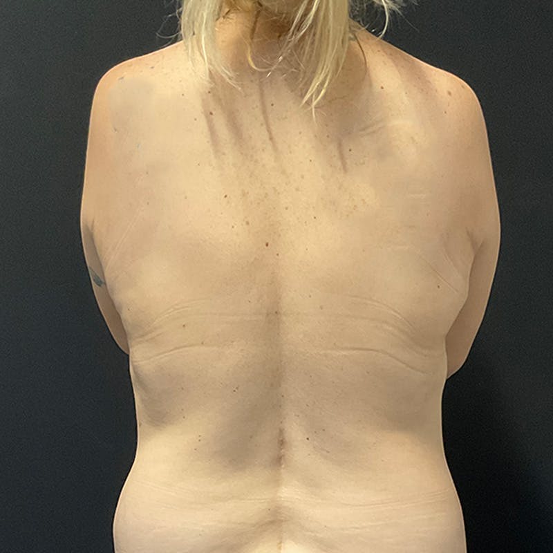 Breast Revision Before & After Gallery - Patient 201508653 - Image 11