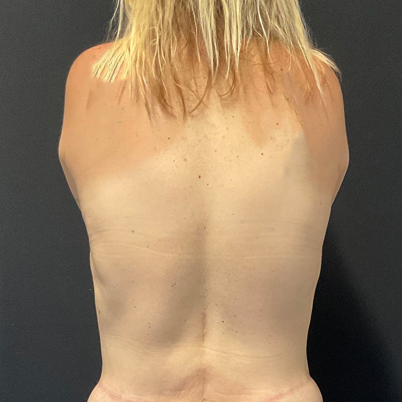 Body Lift Before & After Gallery - Patient 201497925 - Image 12