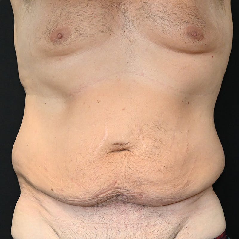 Body Lift Before & After Gallery - Patient 201497757 - Image 1