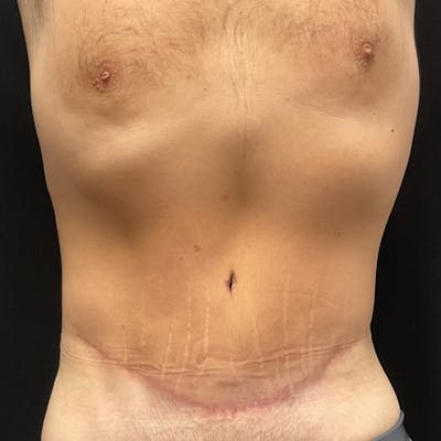 Body Lift Before & After Gallery - Patient 201497757 - Image 2
