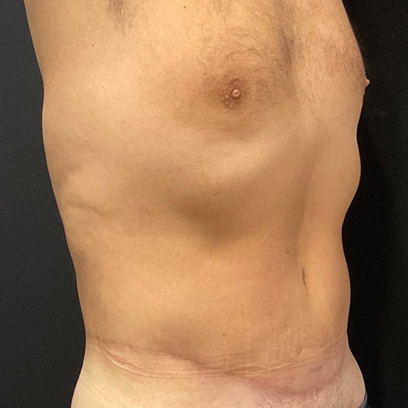 Body Lift Before & After Gallery - Patient 201497757 - Image 4