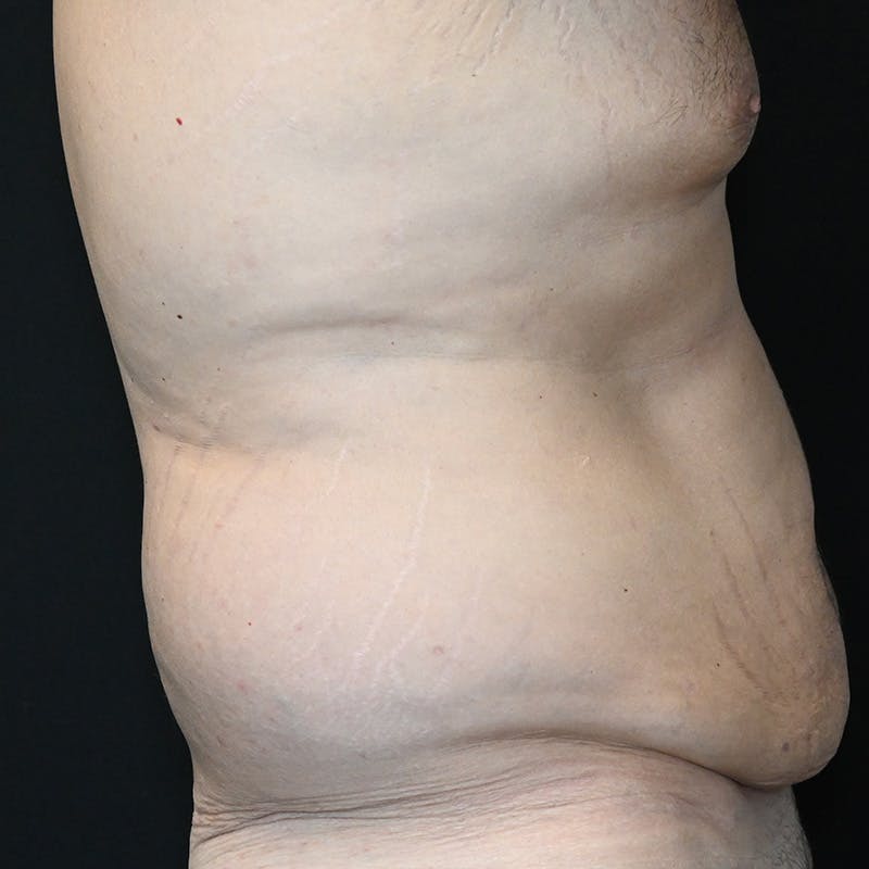 Body Lift Before & After Gallery - Patient 201497757 - Image 5