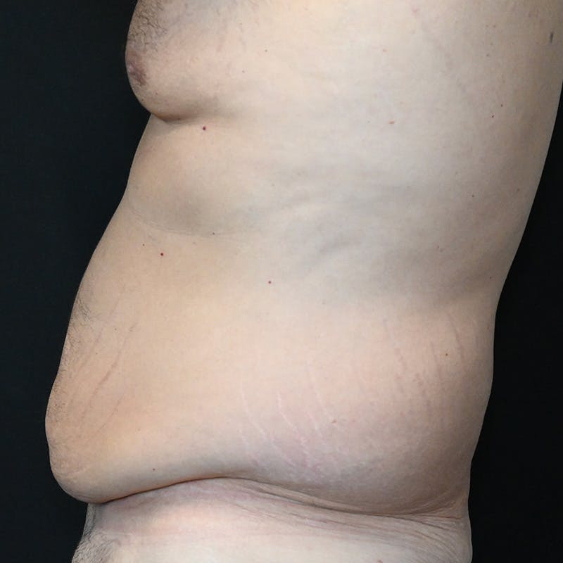 Body Lift Before & After Gallery - Patient 201497757 - Image 9