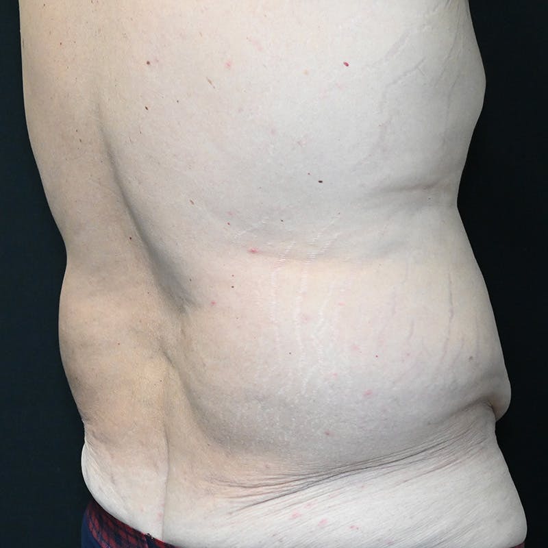 Body Lift Before & After Gallery - Patient 201497757 - Image 11
